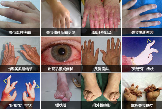 貴陽(yáng)強(qiáng)直醫(yī)院類(lèi)風(fēng)濕癥狀.jpg