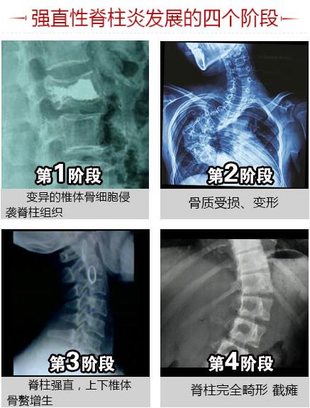 強(qiáng)直性脊柱炎發(fā)展的四個階段.jpg